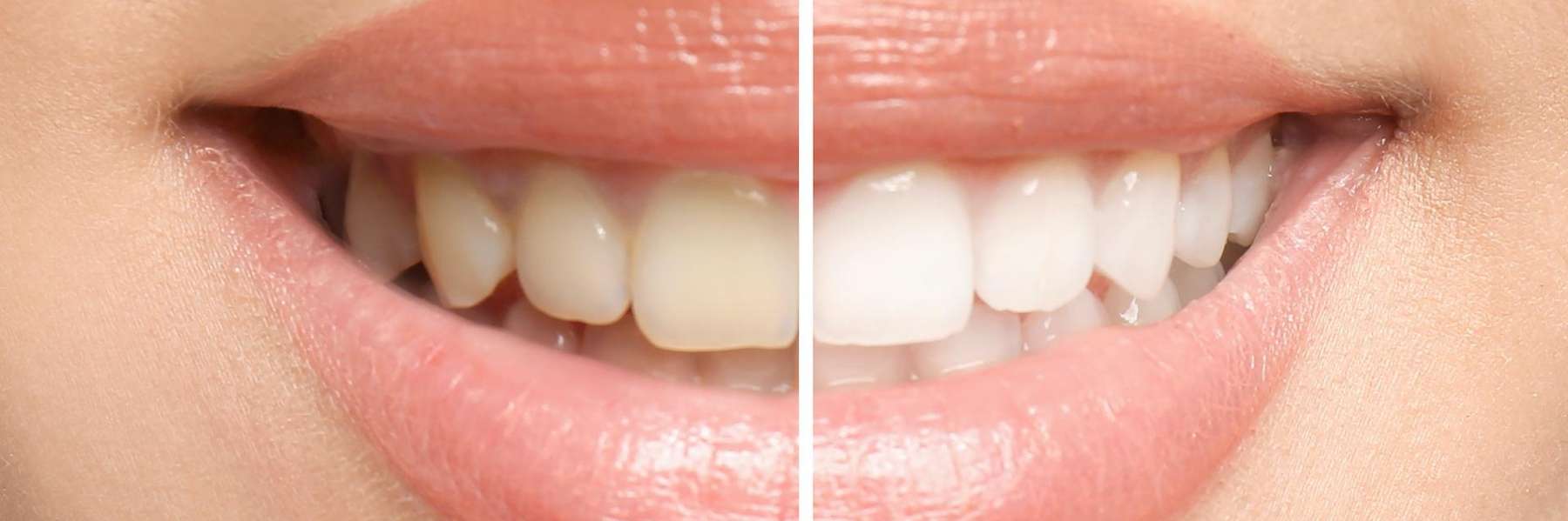 before and after teeth whitening pictures 