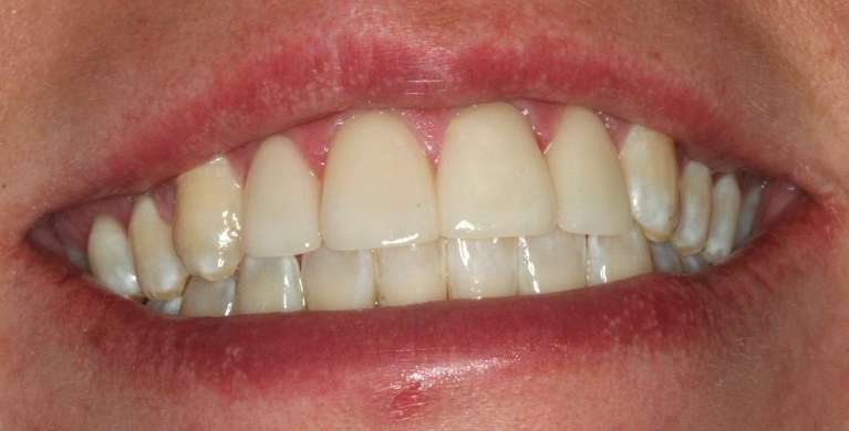 Emergency-to-Repair-Broken-Teeth-After-Image